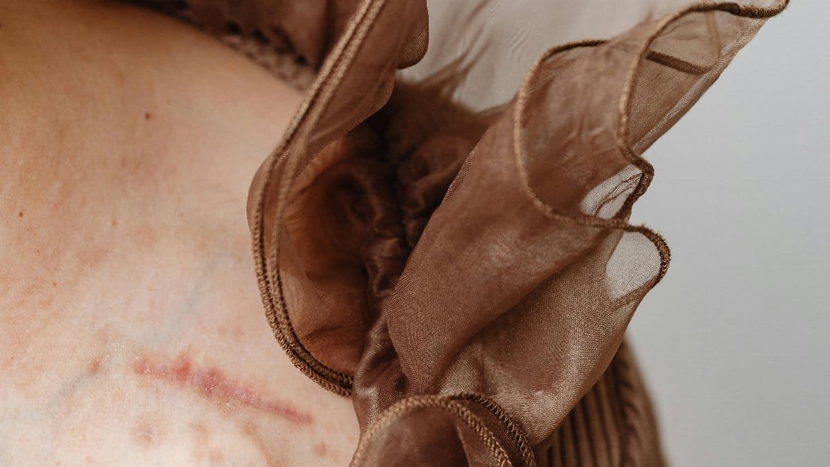Artistic close-up of a woman's shoulder showcasing a scar and delicate tulle fabric. via Pexels