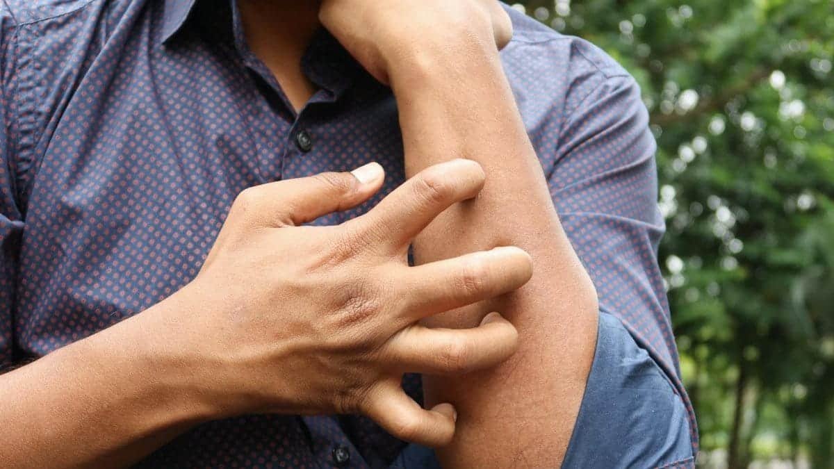 A man in a blue shirt scratching his arm outdoors, highlighting skin irritation.