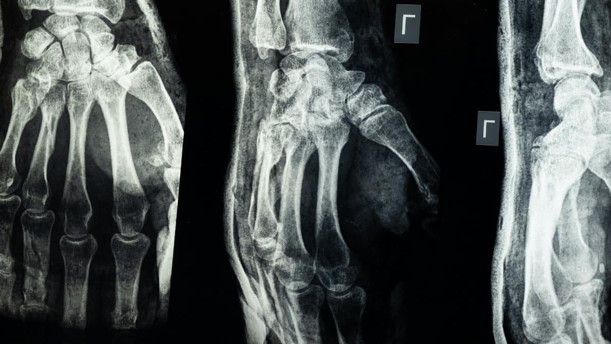 Close-up X-ray showing detailed view of human hand bones.