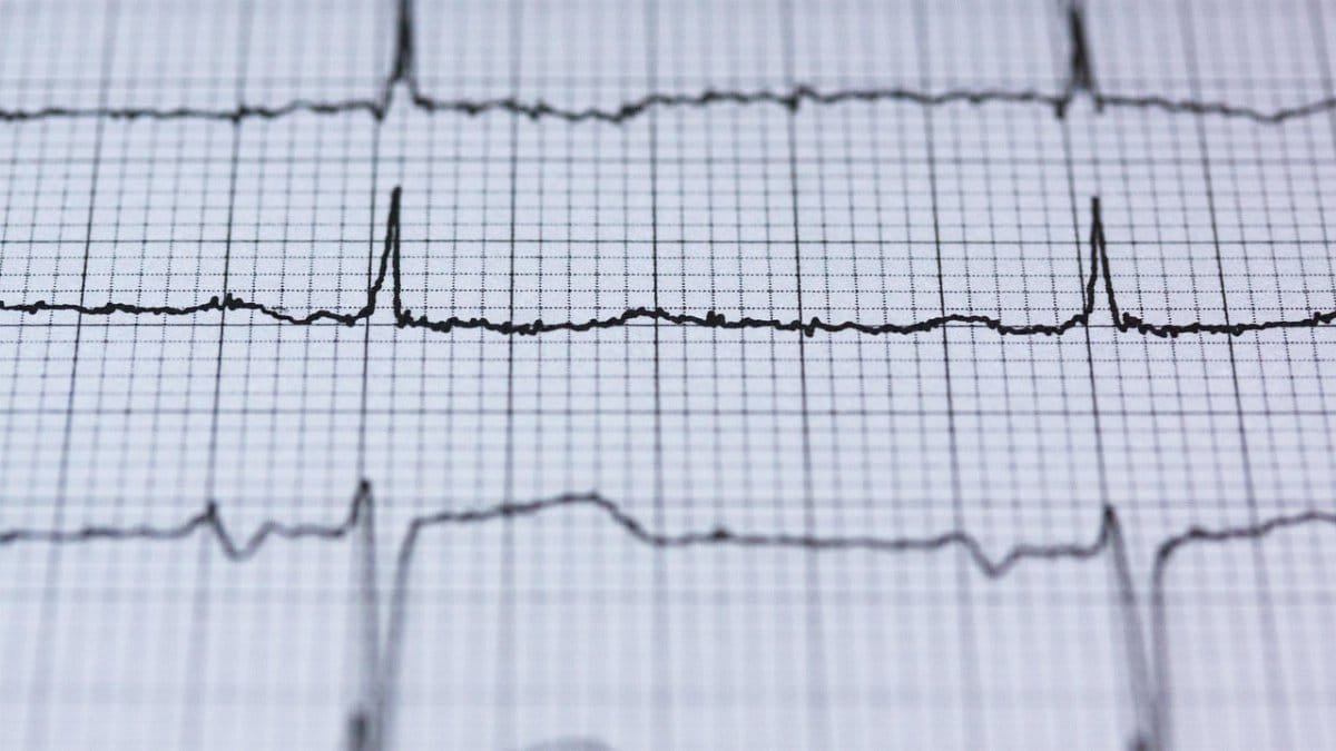ecg, electrocardiogram, medicine, heartbeat, heart, frequency, curve, pulse, life, health, healthcare, circuit, examination, control examination, health check, rhythm, blood pressure, grid, expression, recording, ecg, ecg, ecg, ecg, ecg, electrocardiogram, heartbeat, heartbeat, frequency, blood pressure