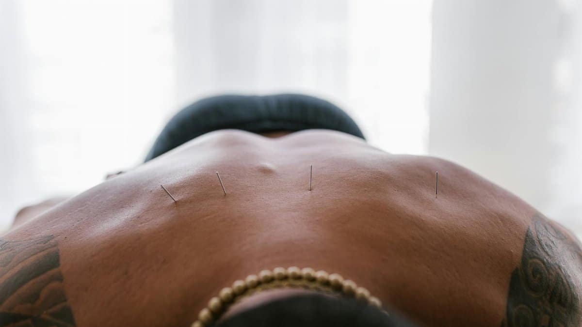 Close-up image of acupuncture needles applied to a person's back during treatment.