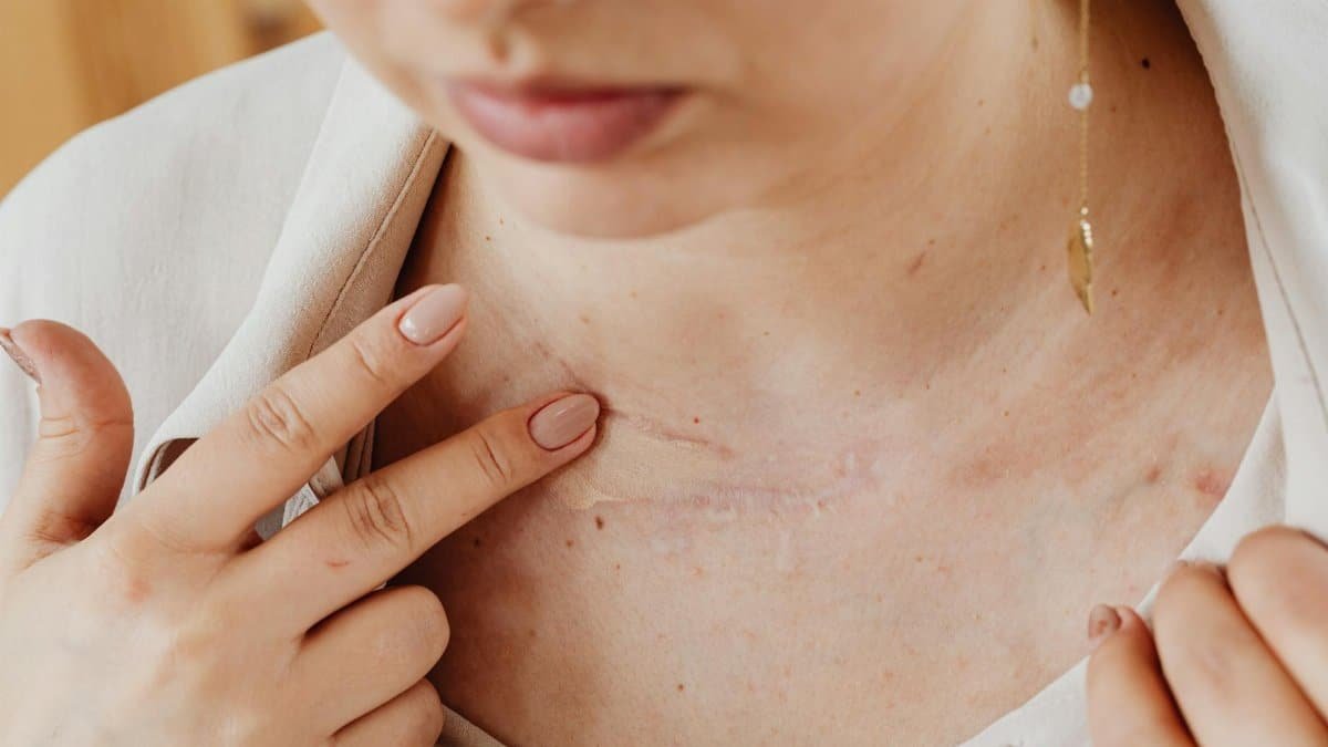 A woman gently applying concealer on a chest scar with manicured nails.
