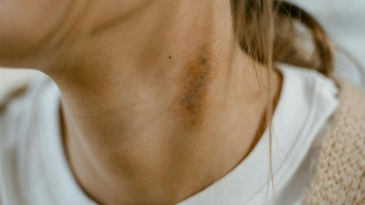Detailed close-up image of a neck showing a visible bruise or scar, emphasizing skin texture.