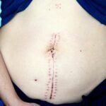 Close-up image showing a healing scar on a woman's abdomen post-surgery.