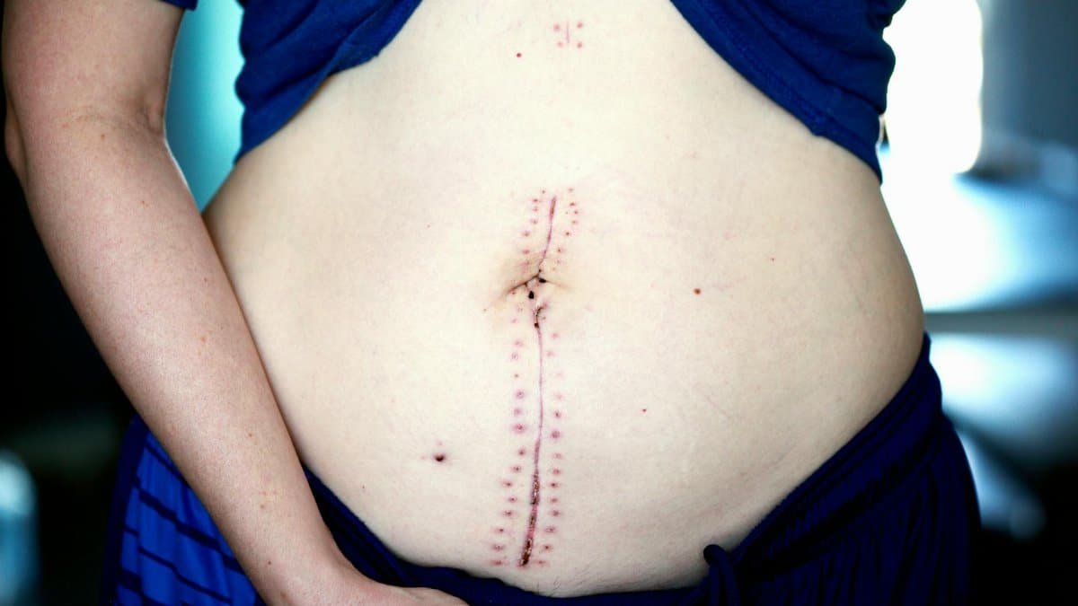 Close-up image showing a healing scar on a woman's abdomen post-surgery.