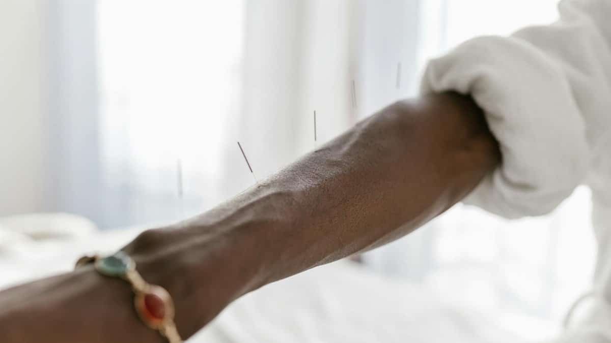 Close-up of acupuncture needles on a person's arm, indicating holistic therapy.