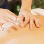 From above of crop anonymous man applying needles on back of client during acupuncture procedure