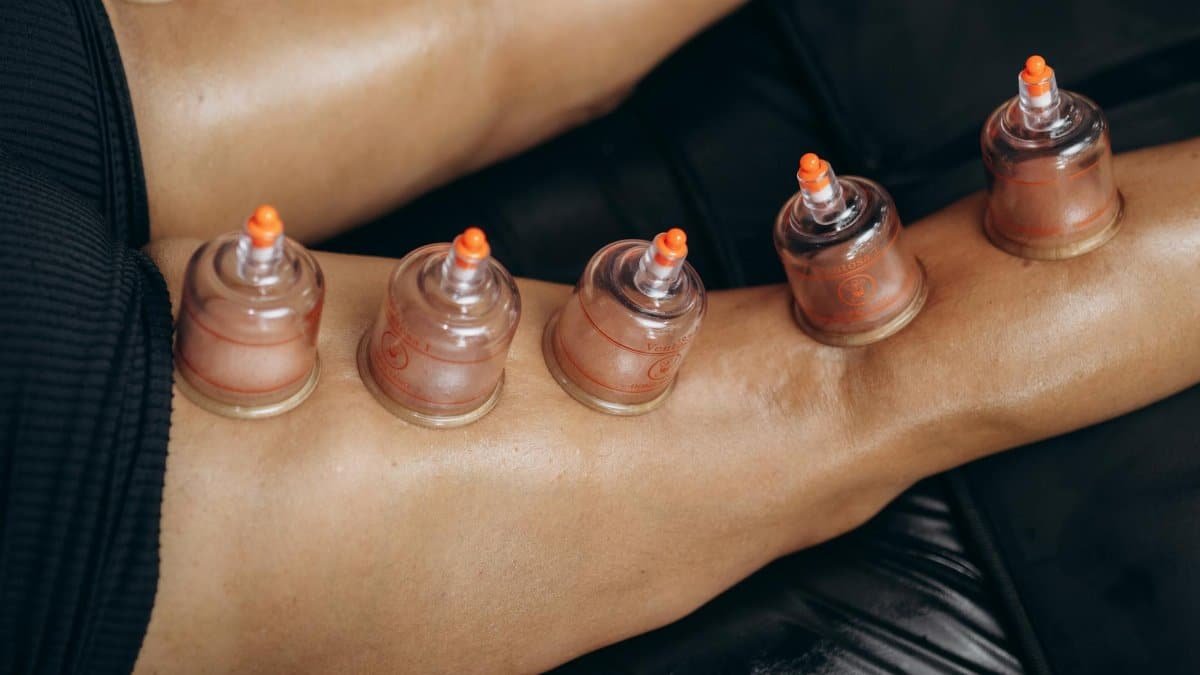 Close-up of cupping therapy on legs, highlighting natural healing and recovery benefits.