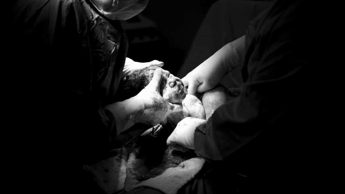 Black and white photo capturing a newborn's first moments in a surgical setting.