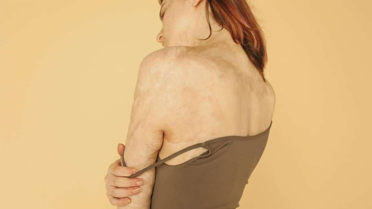 Woman with burn scars in brown tank top on beige background, showcasing resilience.