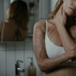 A woman with burn scars poses confidently, promoting body positivity.