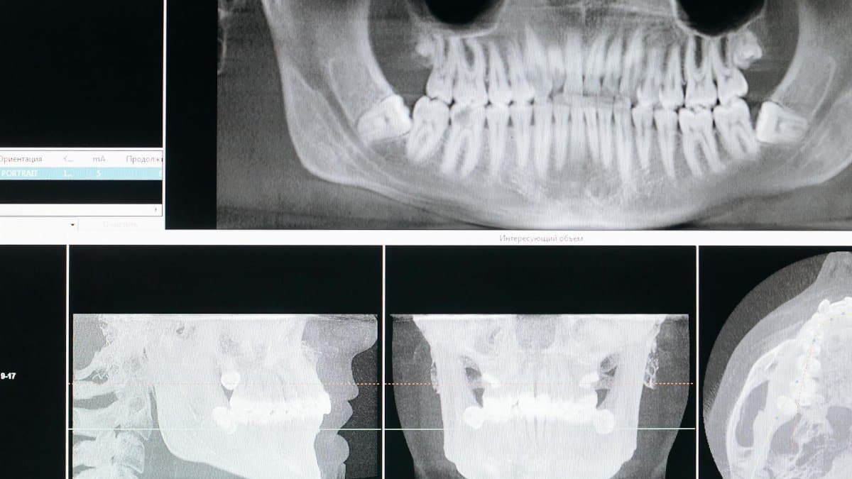 Detail image of a panoramic dental X-ray, showing teeth and jaw structure.