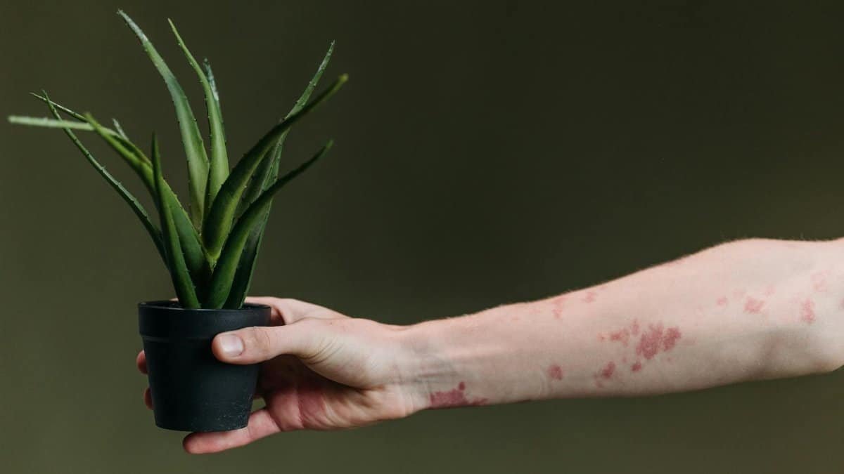 A close-up of a hand with a skin condition holding a potted aloe vera plant against a green background.