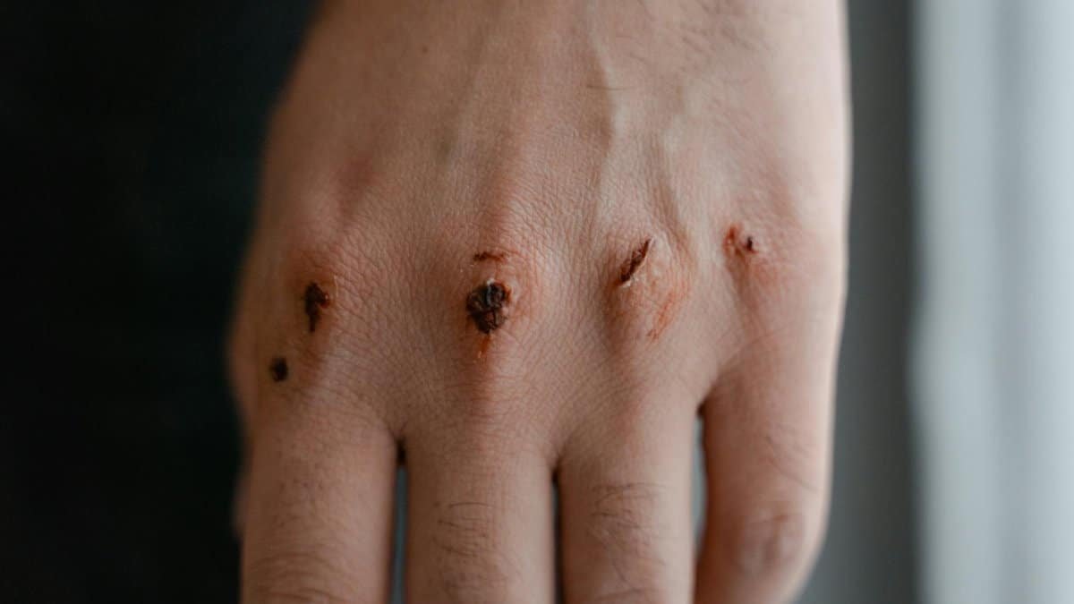Close-up view of a hand showing scars and injuries on the knuckles.