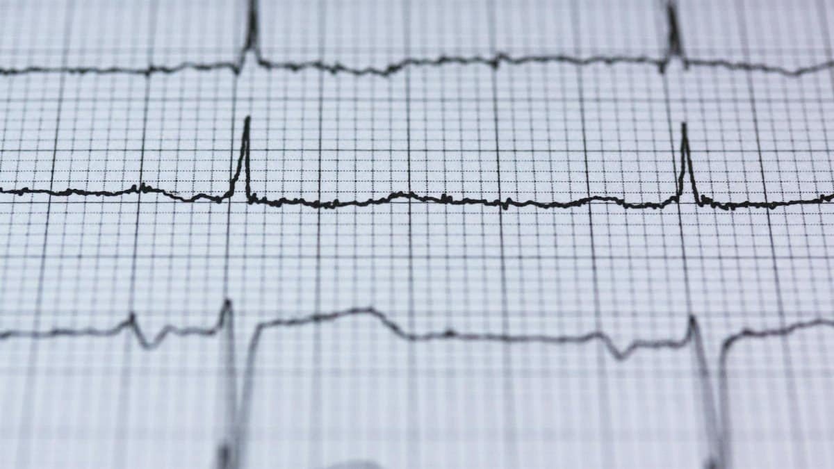 Close-up view of an ECG reading on graph paper, displaying heart rhythm and pulse data for medical analysis.