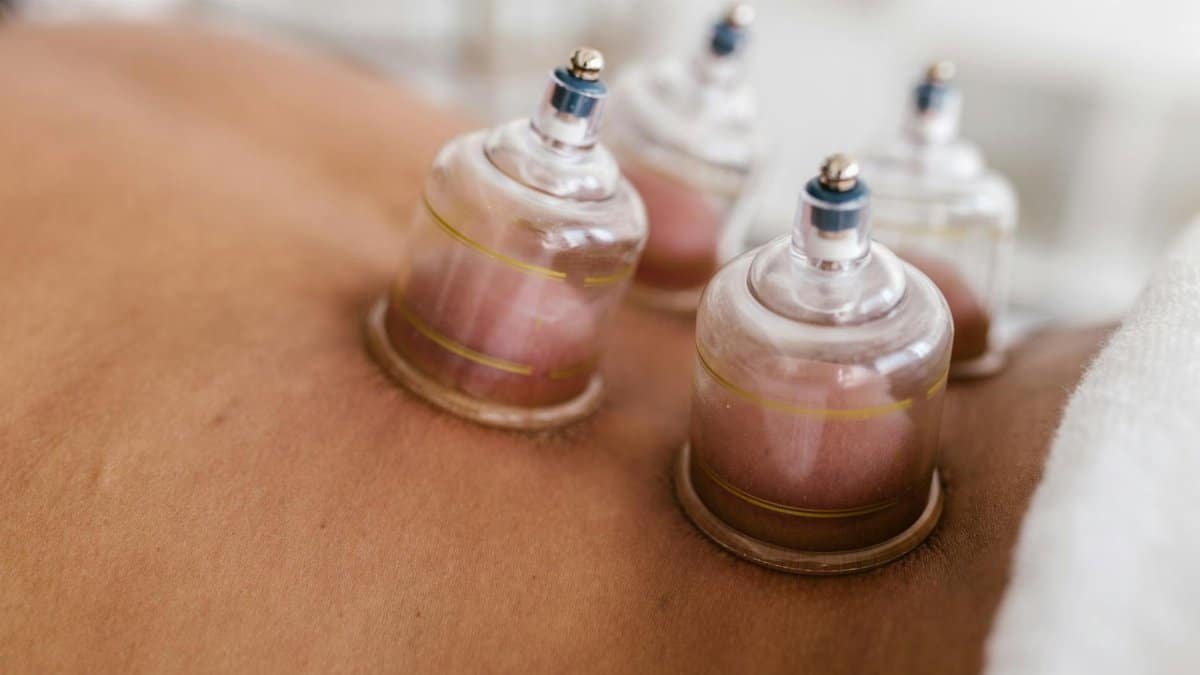Detailed image of cupping therapy on a person's back, showcasing alternative medicine practice.
