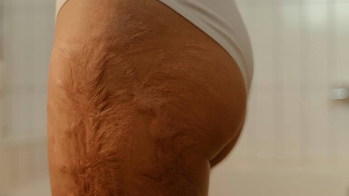 Detailed close-up of scarred skin on a thigh, highlighting texture and healing process.