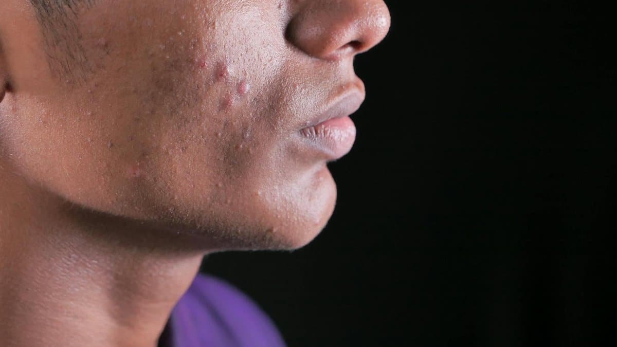 Side view close-up of a young man's face with visible acne on cheek and jawline.