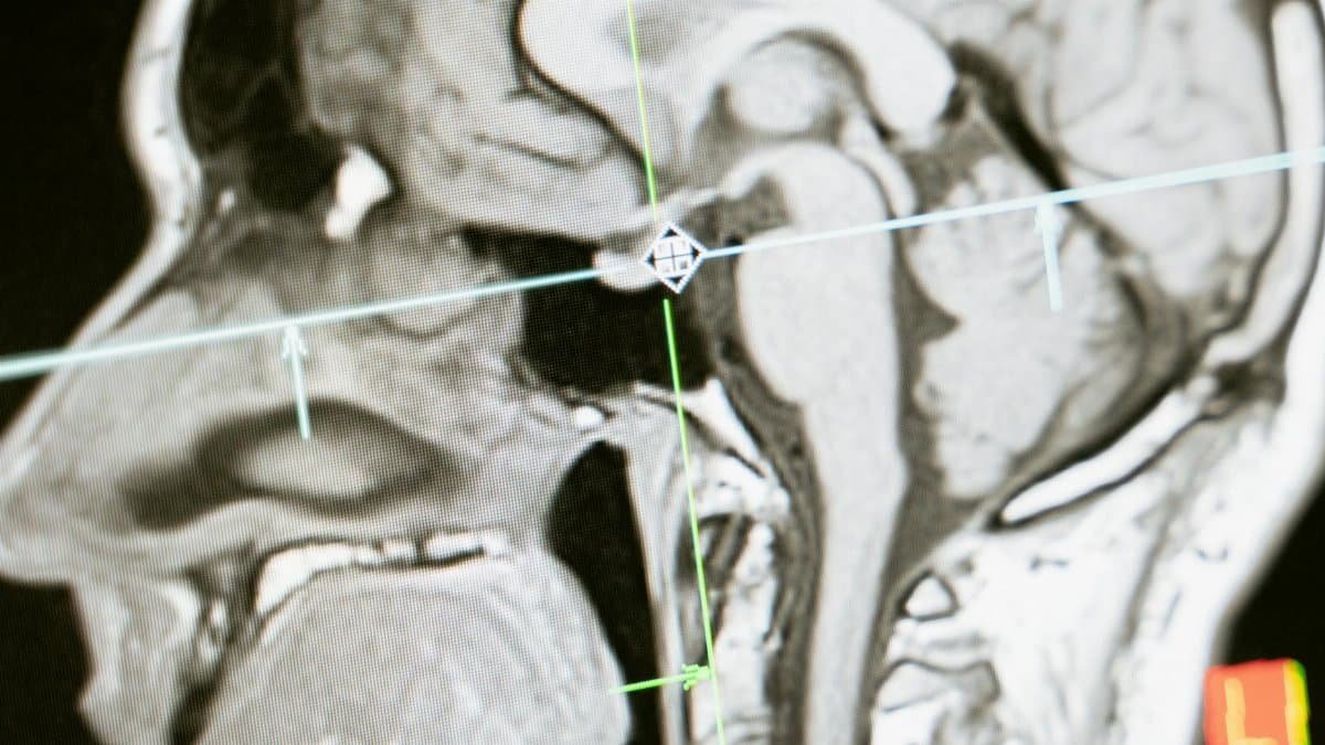 Close-up of an MRI scan showing a sagittal view of the human brain for analysis.