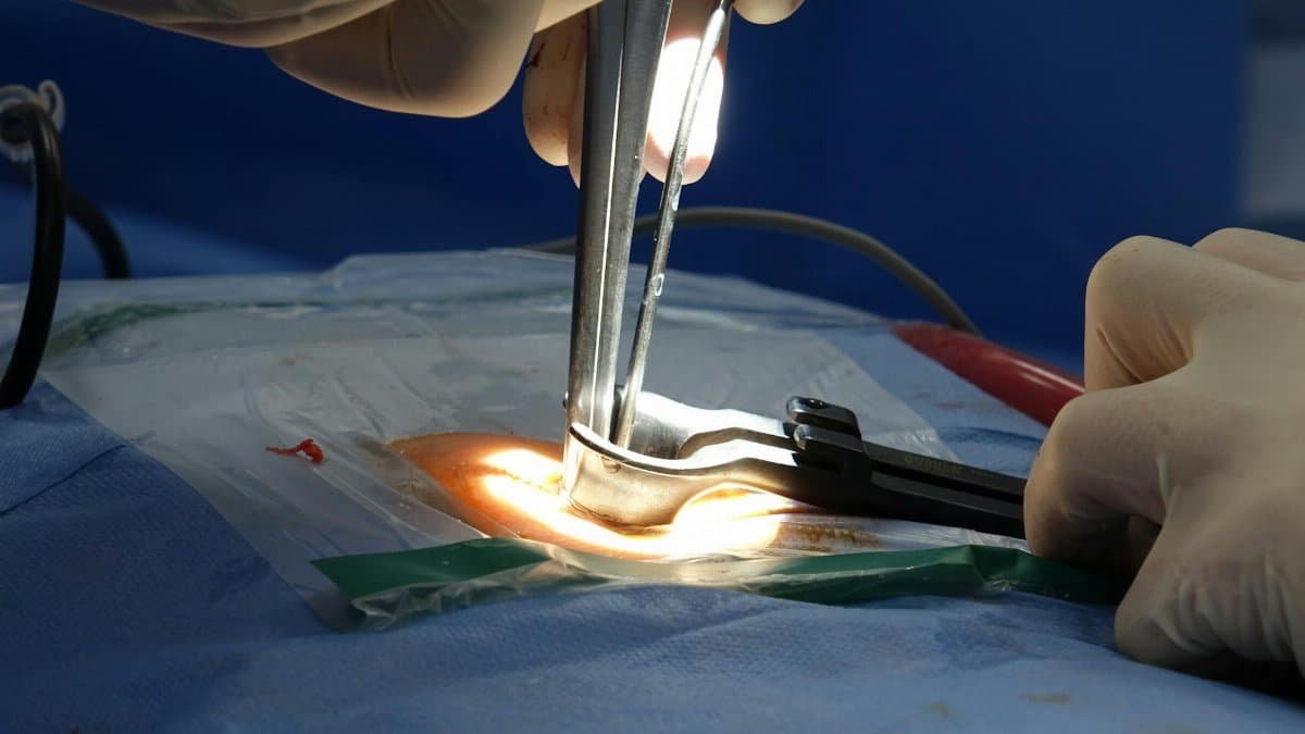 Detailed view of a spinal surgery in a hospital operating room focusing on surgical tools.