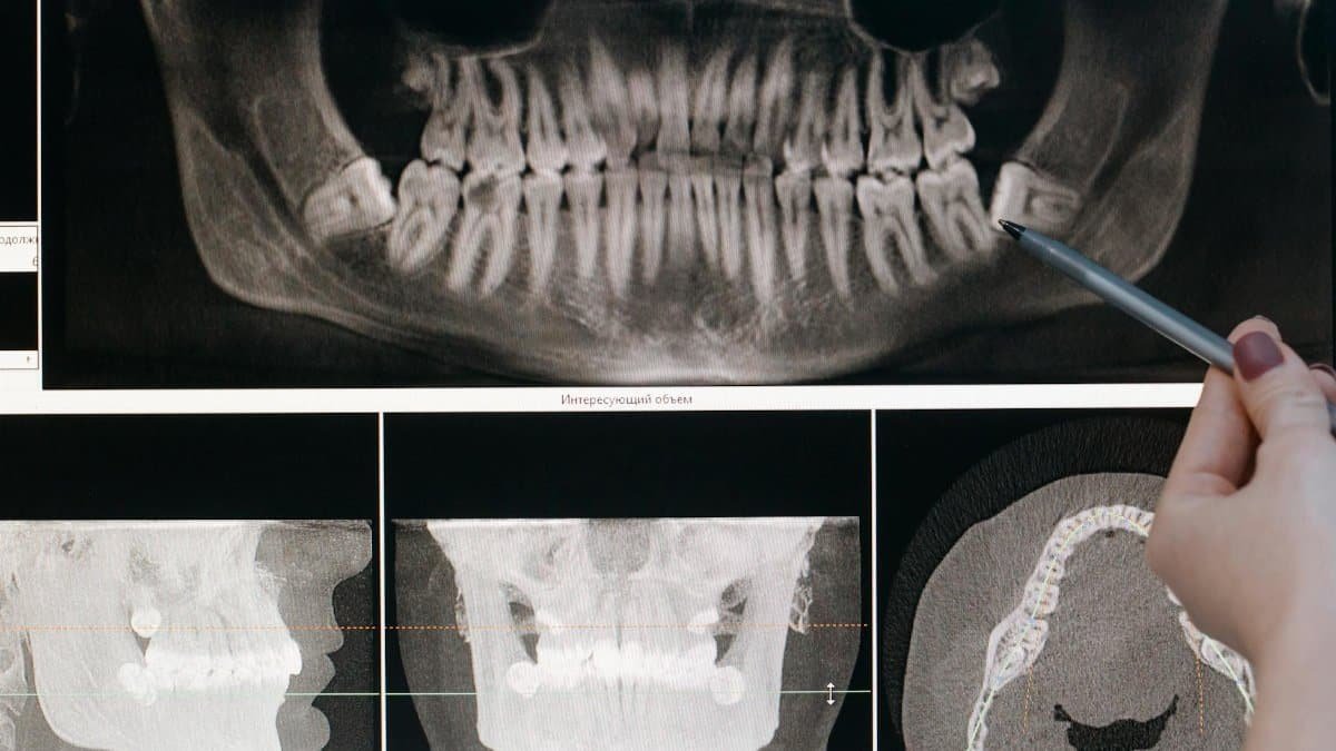 Detailed dental X-ray showing teeth structure highlighted by a pointing pen.