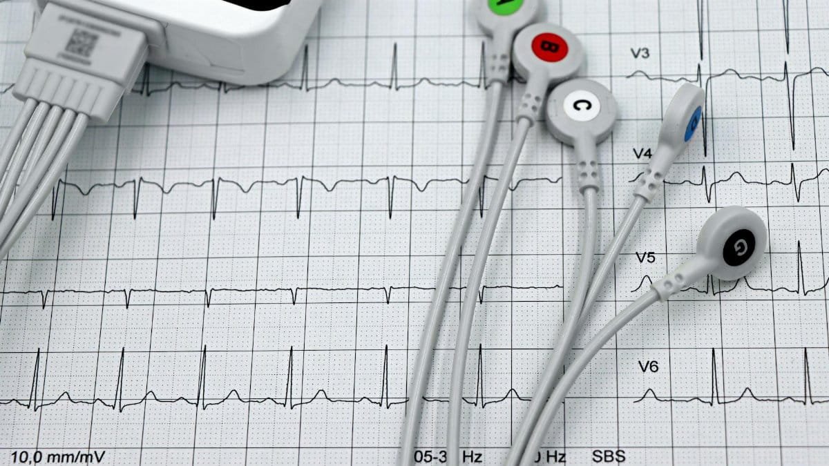Close-up of ECG monitor leads on a printed cardiogram, showcasing heart health diagnostics.