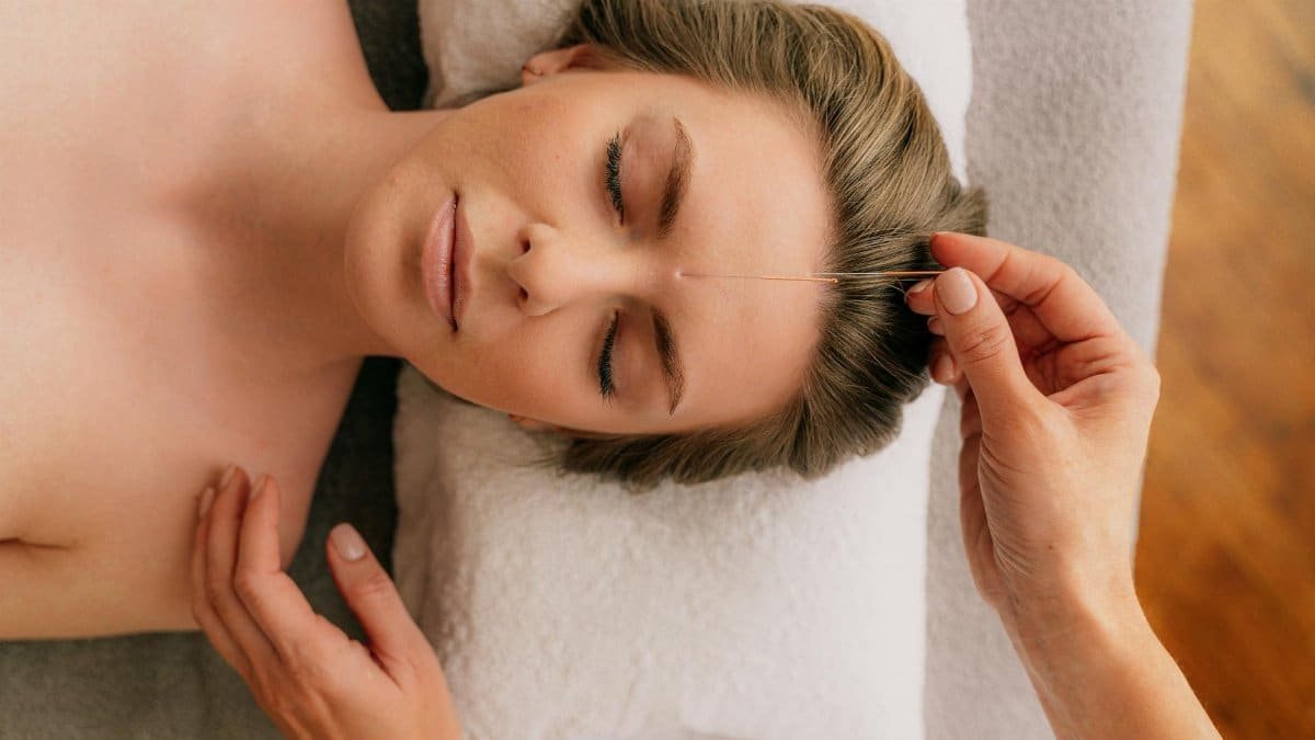Serene acupuncture treatment focusing on relaxation and wellness in a spa setting.