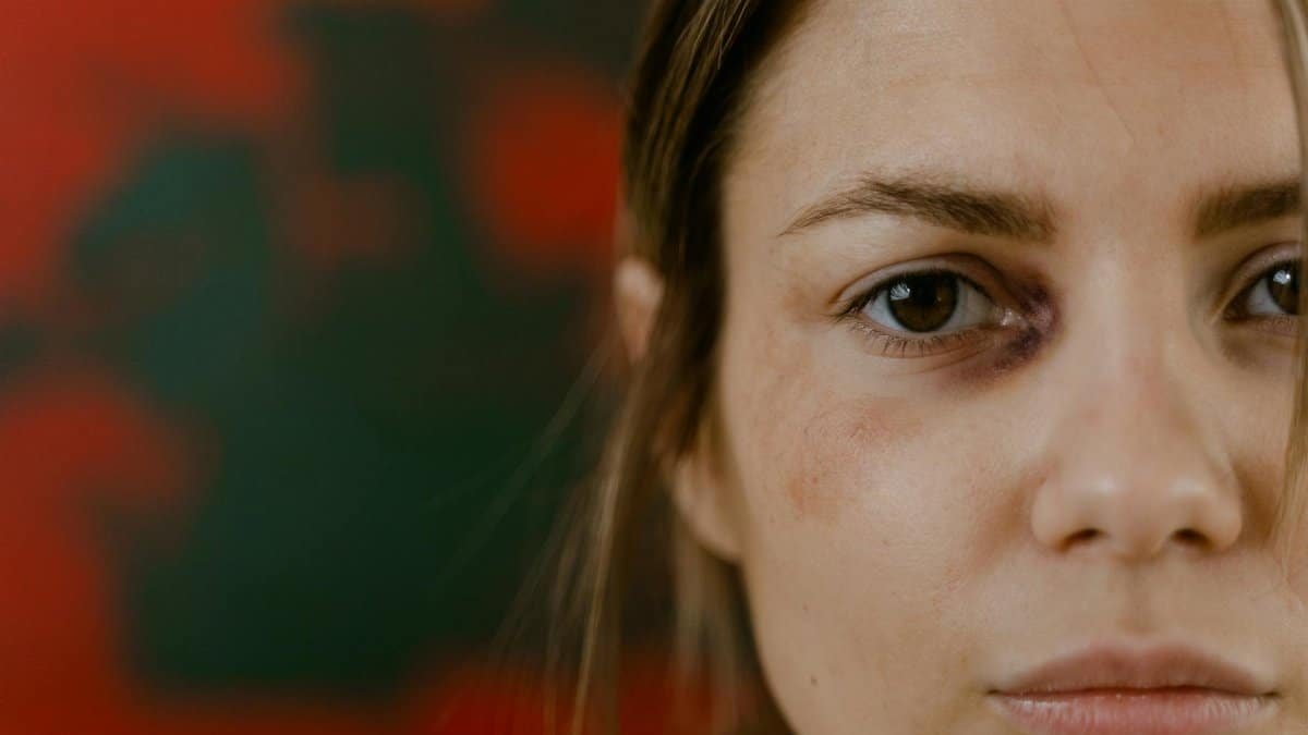 Close-up portrait of a woman with a bruised eye, depicting emotion and resilience.