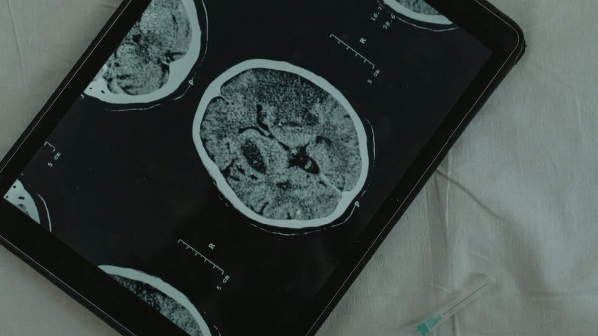 Close-up view of a brain CT scan displayed on a digital tablet with a medical needle beside it.