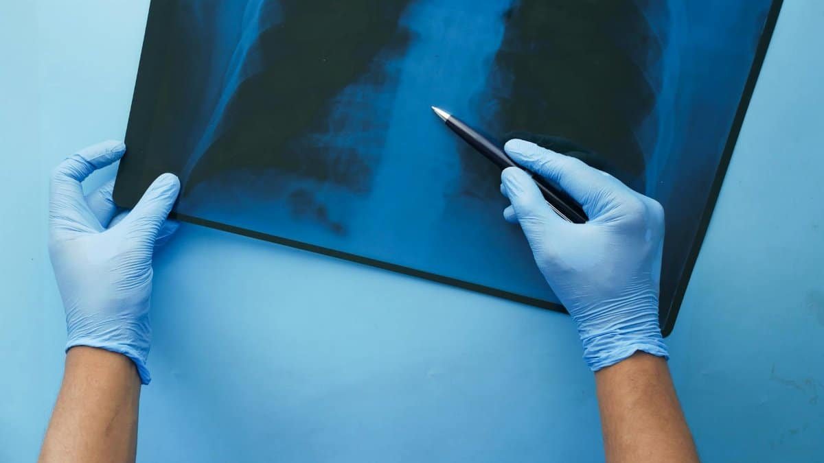 A doctor in blue gloves examines a chest x-ray with a pen, focusing on medical diagnosis.