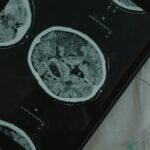 Close-up view of a brain CT scan displayed on a digital tablet with a medical needle beside it.