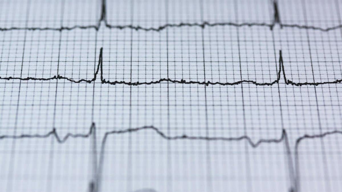 Close-up view of an ECG reading on graph paper, displaying heart rhythm and pulse data for medical analysis.