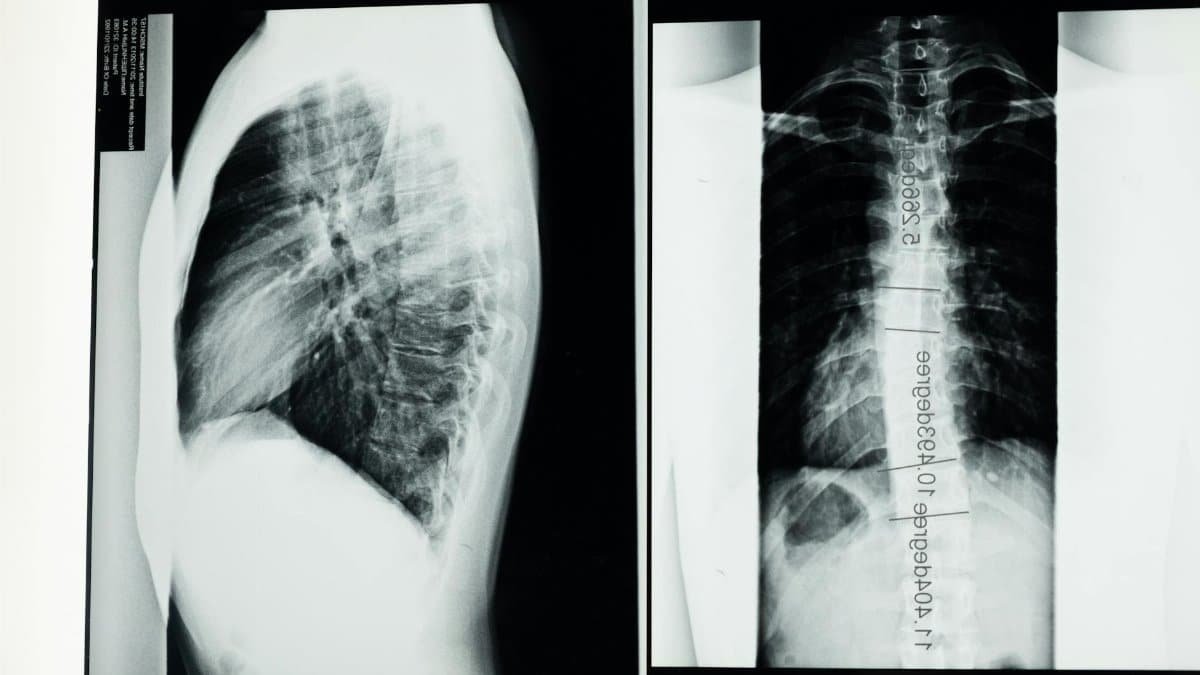 High-resolution X-ray showing a detailed examination of human spine with scoliosis.