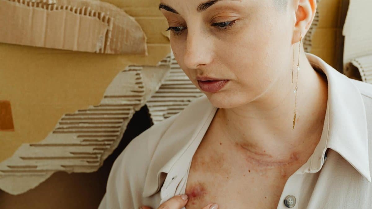 Close-up of a woman showing healing bruises on her chest with a thoughtful expression.