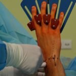 Detail of a hand surgery in an operating room with medical tools.