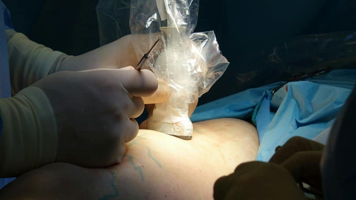 Close-up of a surgical procedure using ultrasound guidance and precise medical instruments.