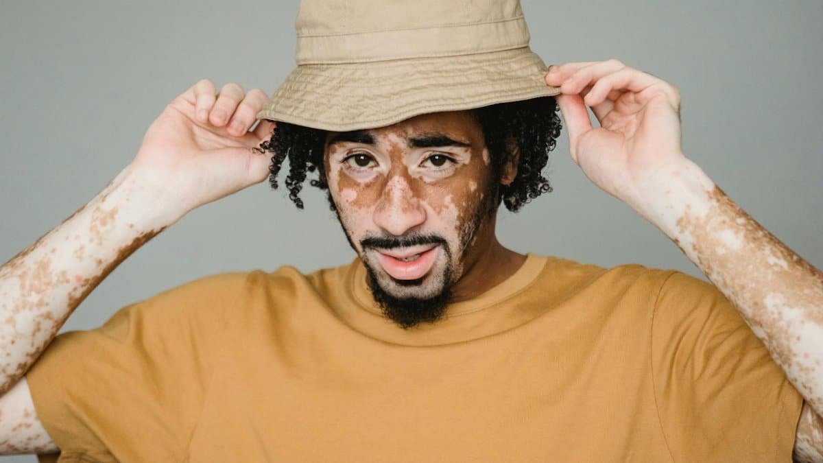 Young African American male with vitiligo patches putting on headgear while representing unique appearance in studio