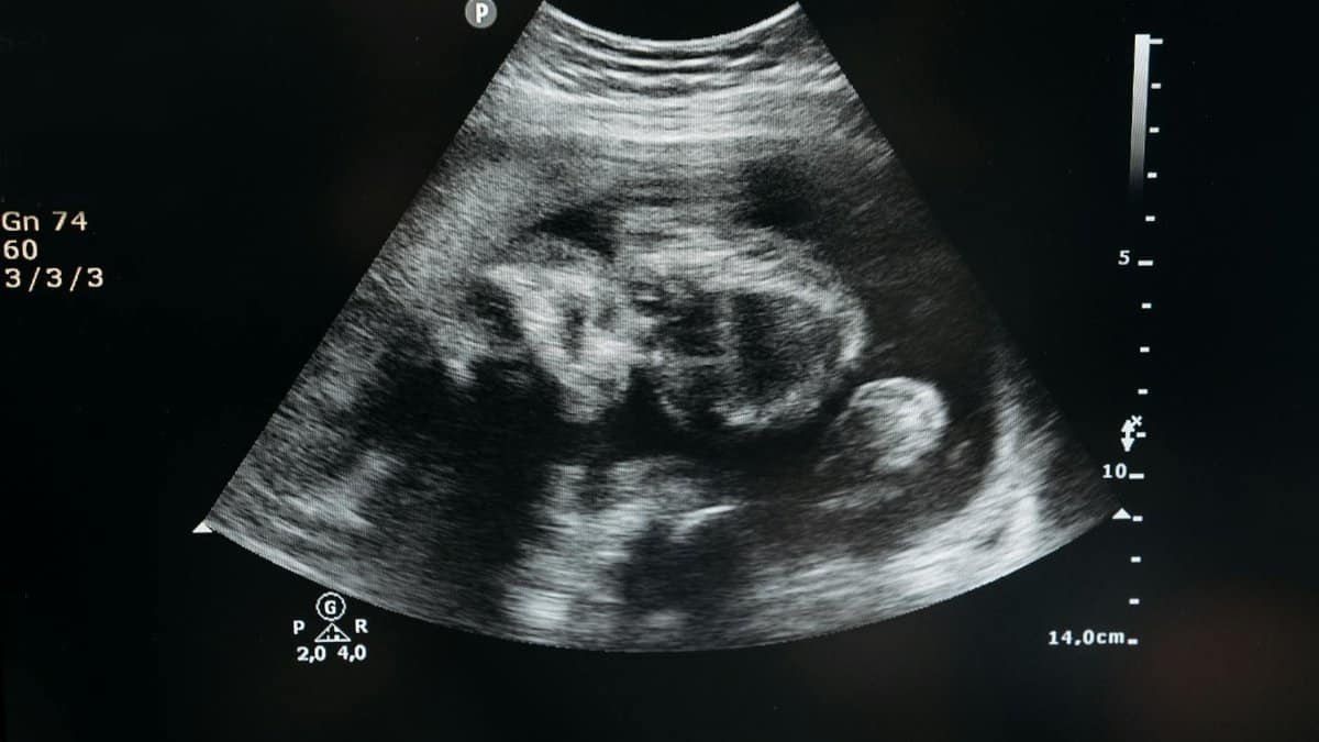 Ultrasound scan showing the image of an unborn child in the womb, highlighting pregnancy and healthcare.