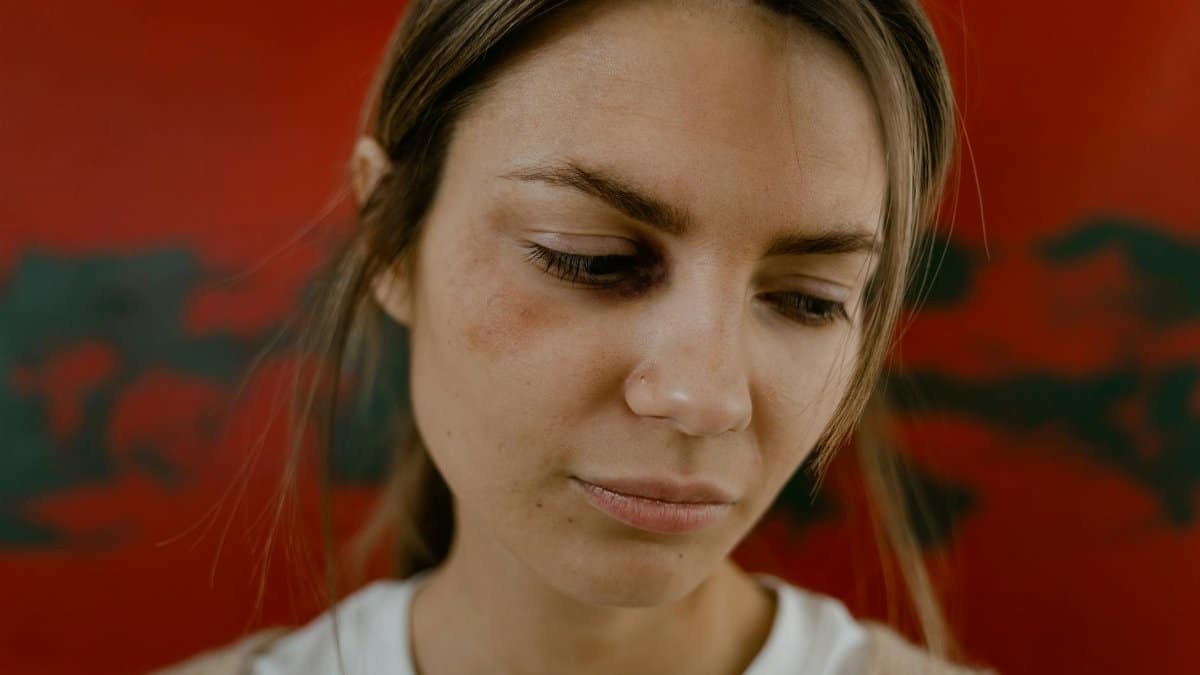 Close-up of a woman with a bruised eye looking down, set against a red background.