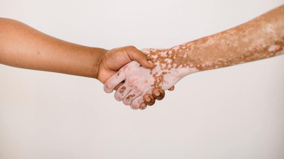 Crop anonymous man shaking hand of male friend with vitiligo skin against white background
