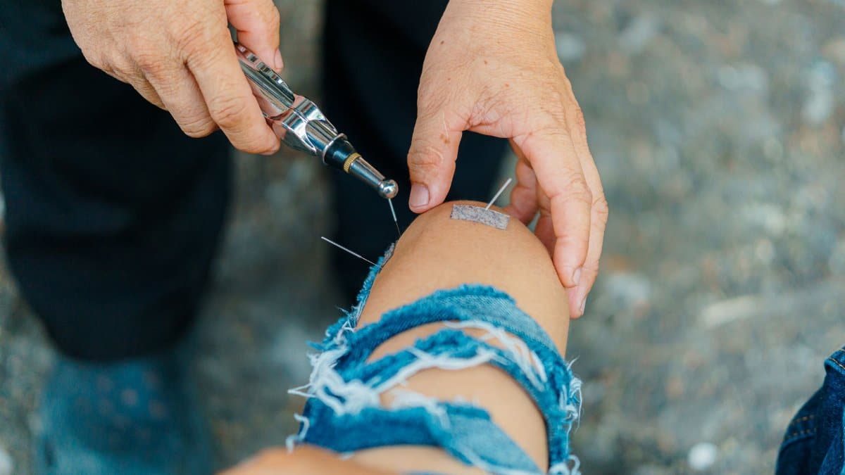 Close-up of acupuncture treatment on a person's knee outdoors, emphasizing natural healing.