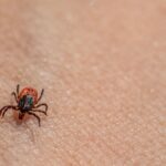 Macro image of a tick on human skin, highlighting textures and details.