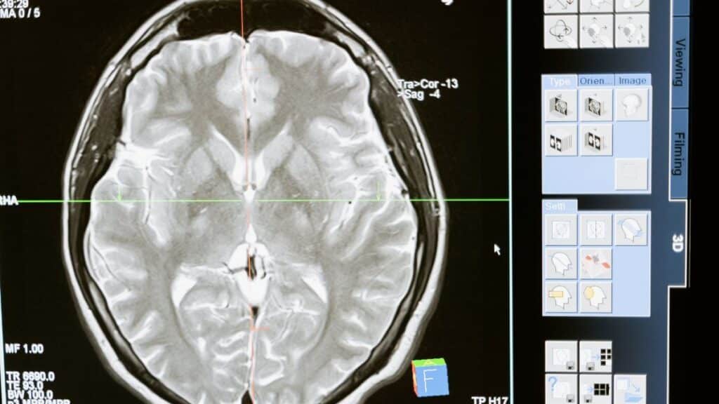 Intricate MRI brain scan displayed on a computer screen for medical analysis and diagnosis.