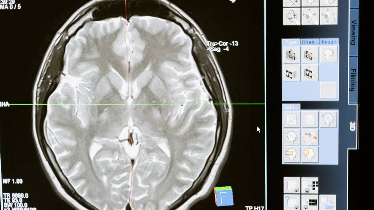 Intricate MRI brain scan displayed on a computer screen for medical analysis and diagnosis.