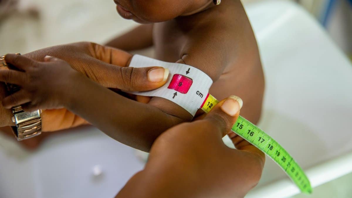 A healthcare professional measures a child's arm using MUAC tape for malnutrition assessment.