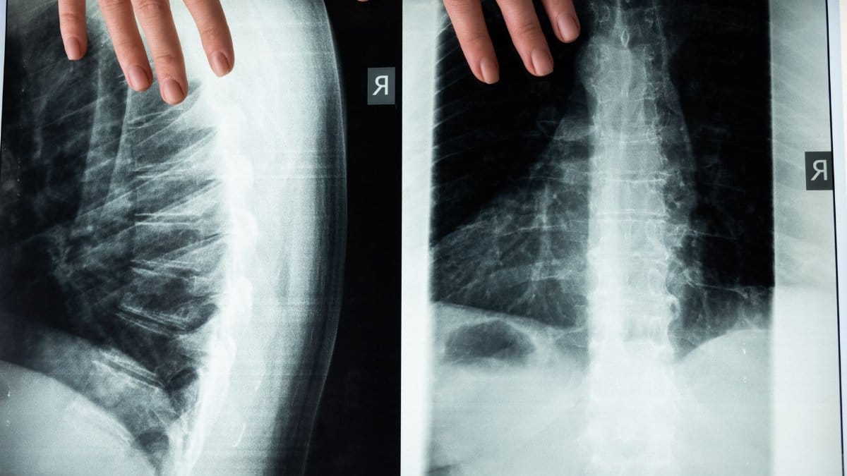 An illustrative close-up of a spine X-ray with hands, highlighting medical imaging and anatomy.