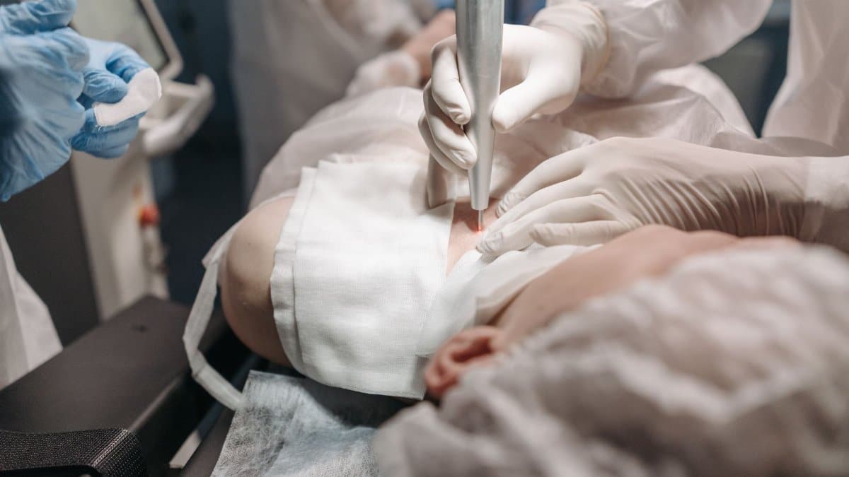Medical professionals performing laser skin treatment in a clinical setting.