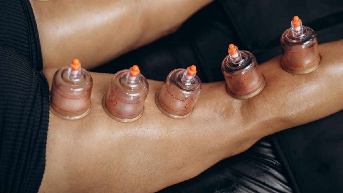 Close-up of cupping therapy on legs, highlighting natural healing and recovery benefits.