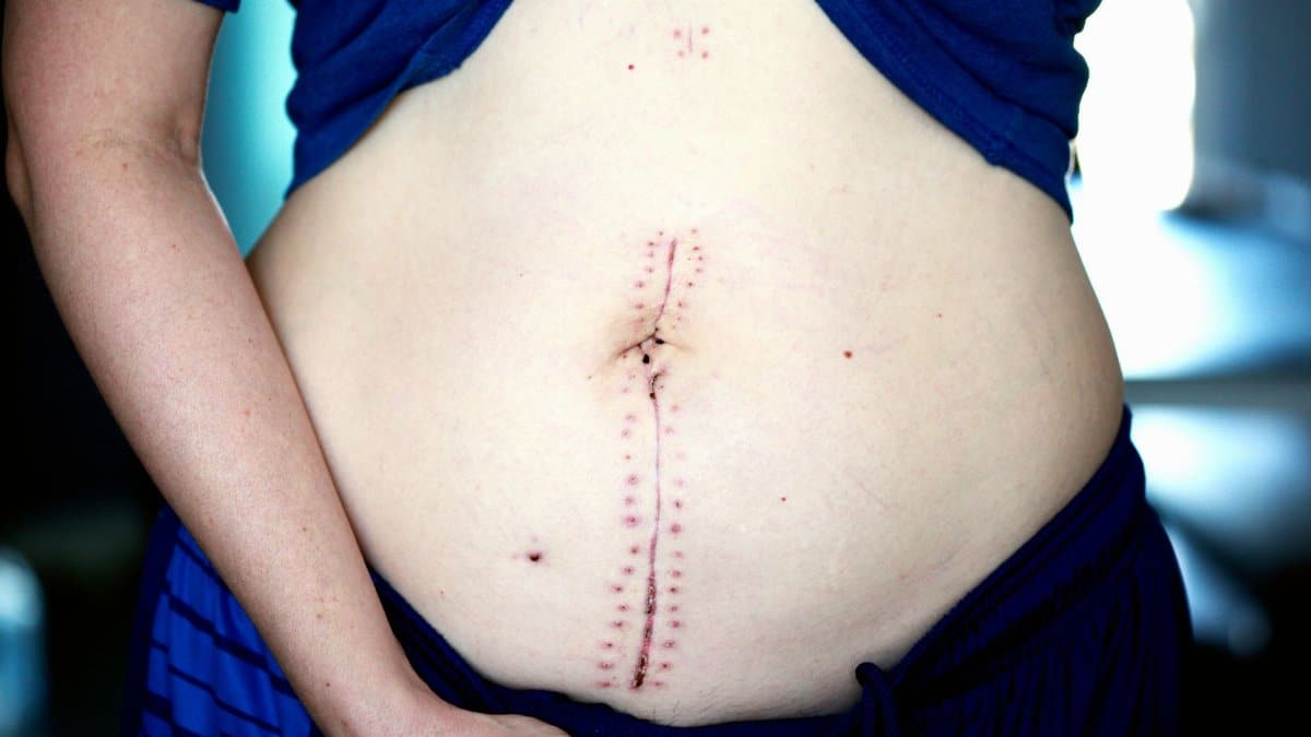 Close-up image showing a healing scar on a woman's abdomen post-surgery.