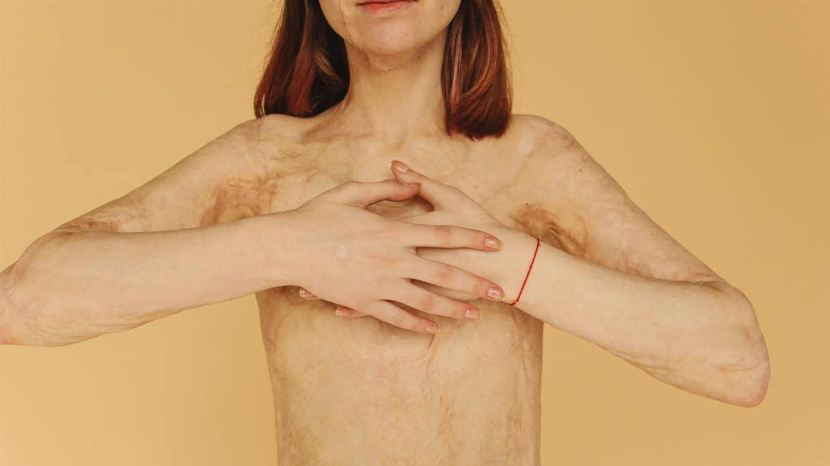 Empowering close-up portrait of a woman with burn scars on a yellow background.